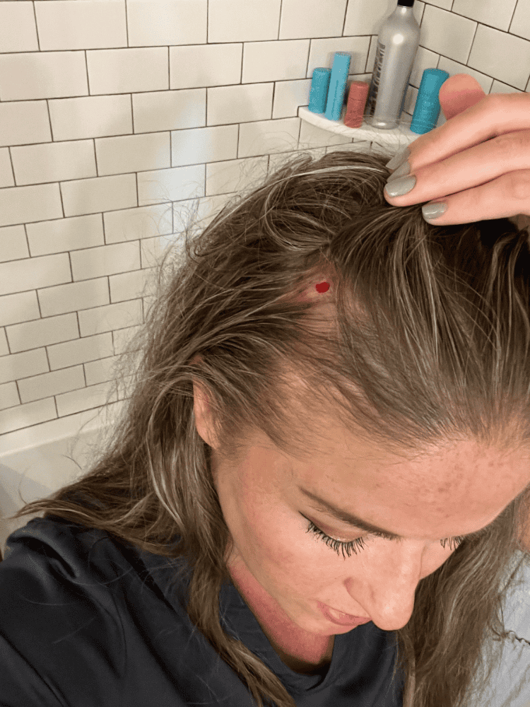 After Scalp Biopsy