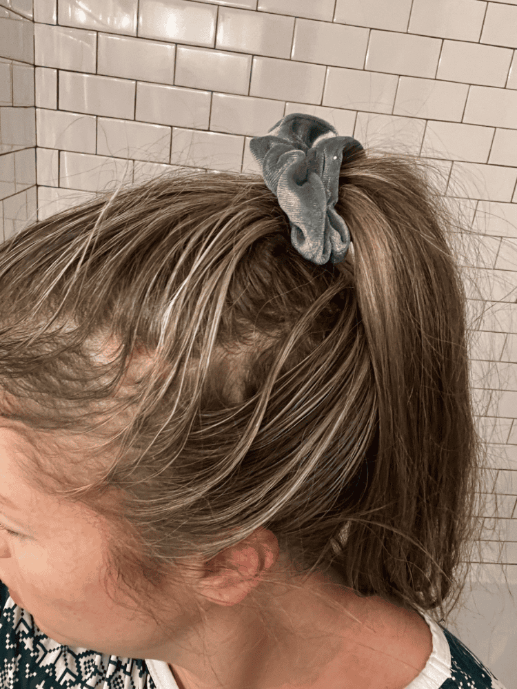 How To Treat Women's Hair Loss