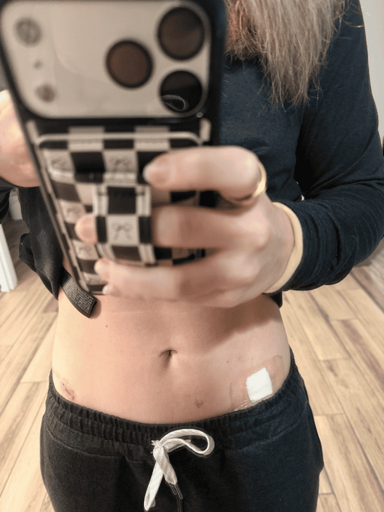 Endometriosis Excision Scars