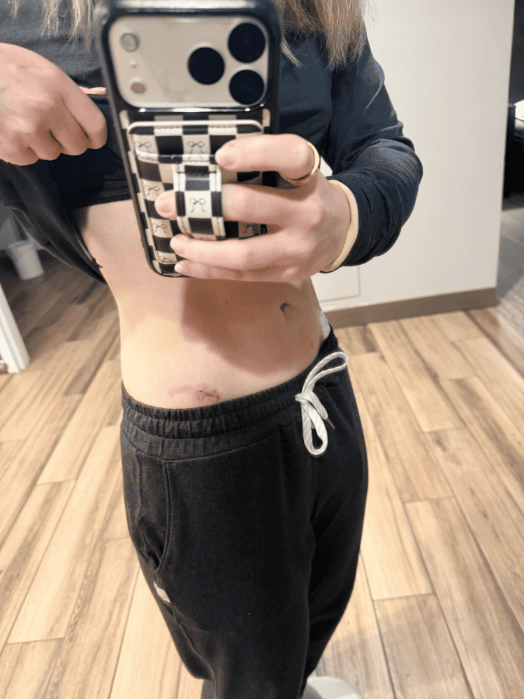 Scars From Endometriosis Excision Surgery